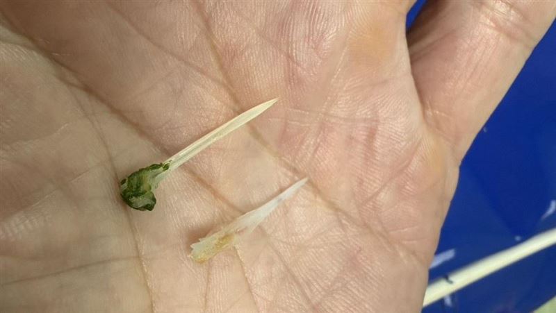 男胸痛以為心梗！醫挖2根50元硬幣大魚刺