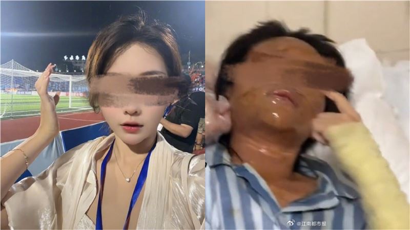 周姓女直播主打開不明包裹爆炸，面部焦黑，二度燒傷，手臂三度燒傷。（圖／翻攝自微博）