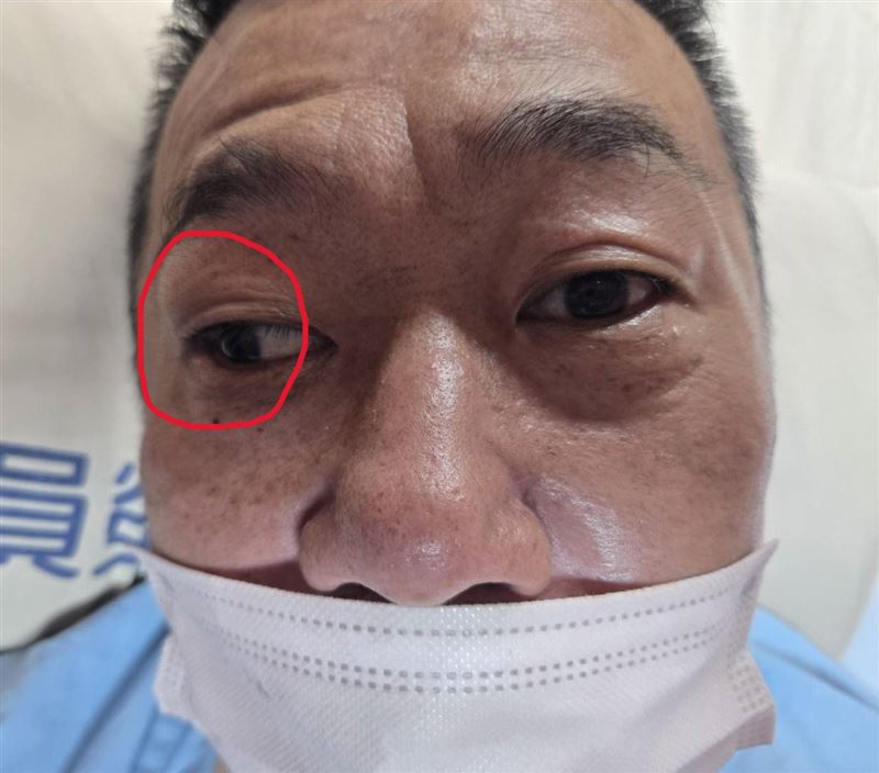 彰化50多歲黃姓男子午休醒來驚覺右眼歪斜,被診斷出缺血性腦中風。(圖/員榮醫院提供)