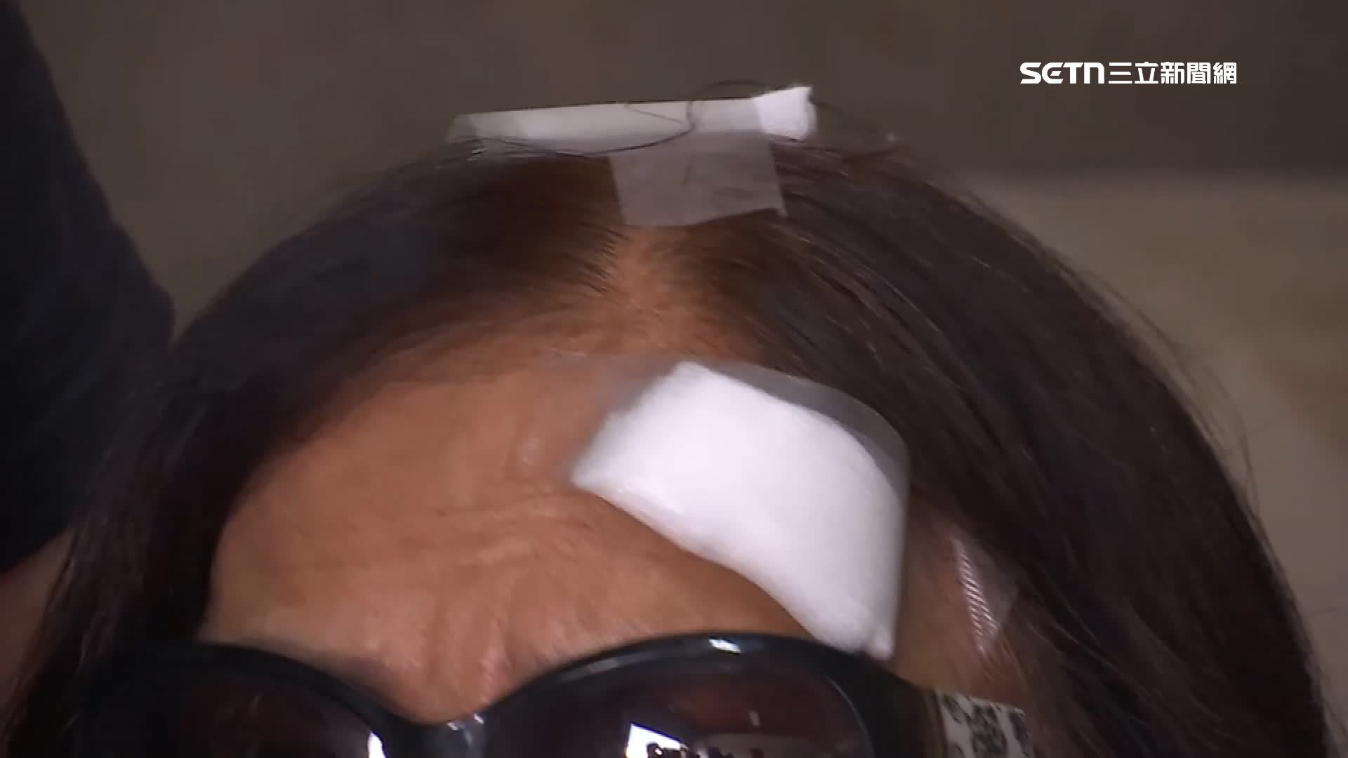 頭頂、額頭都還包紮繃帶紗布