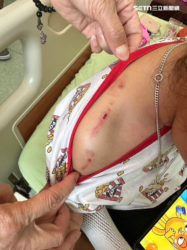 女童頭部、背部、手臂及腹部均有多處咬傷與撕裂傷，部分傷口深可見血，頭皮甚至被撕裂出血。(圖/翻攝畫面)
