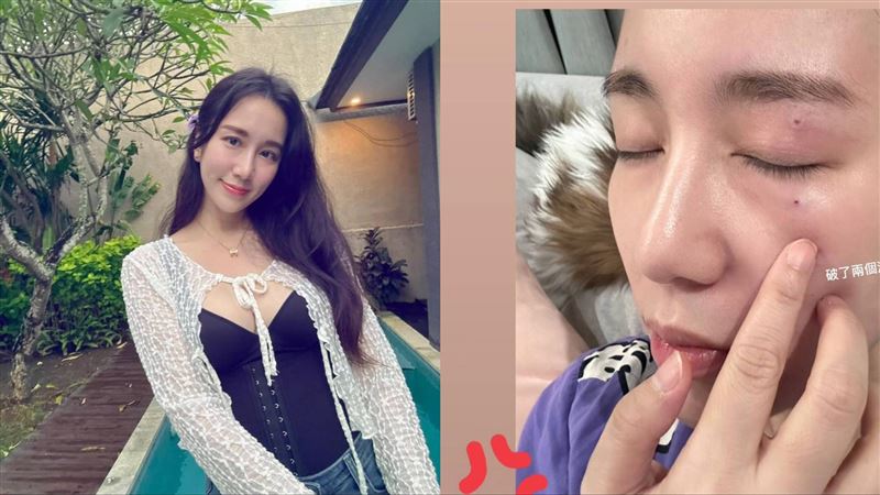 Apple眼睛周圍破2洞　證實被他丟1物砸臉