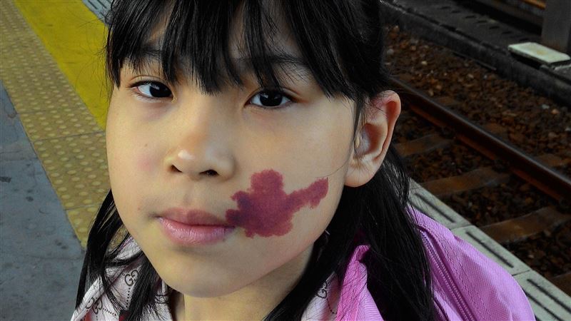 血管瘤女孩臉有「蝴蝶印記」忍痛6年雷射