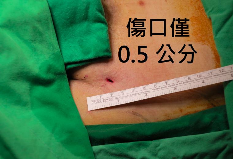 與傳統手術相比,客製化胸主動脈開窗支架手術僅針孔小傷口,傷口僅約0.5公分。(圖/北榮提供)