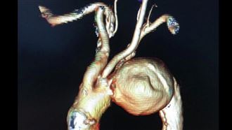 他腦部藏「8cm動脈瘤」北榮1招免開胸拆彈