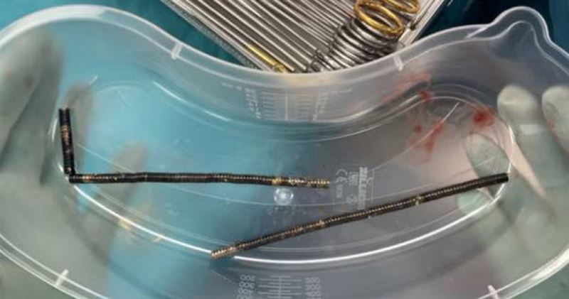 男童腸道內被發現排列成串的強力磁鐵,醫師手術後取出一算竟有近100顆。(圖/翻攝自紐西蘭醫學期刊)