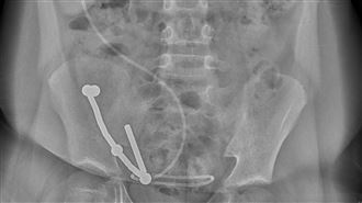 少年誤吞近100顆強力磁鐵！醫急切腸救命