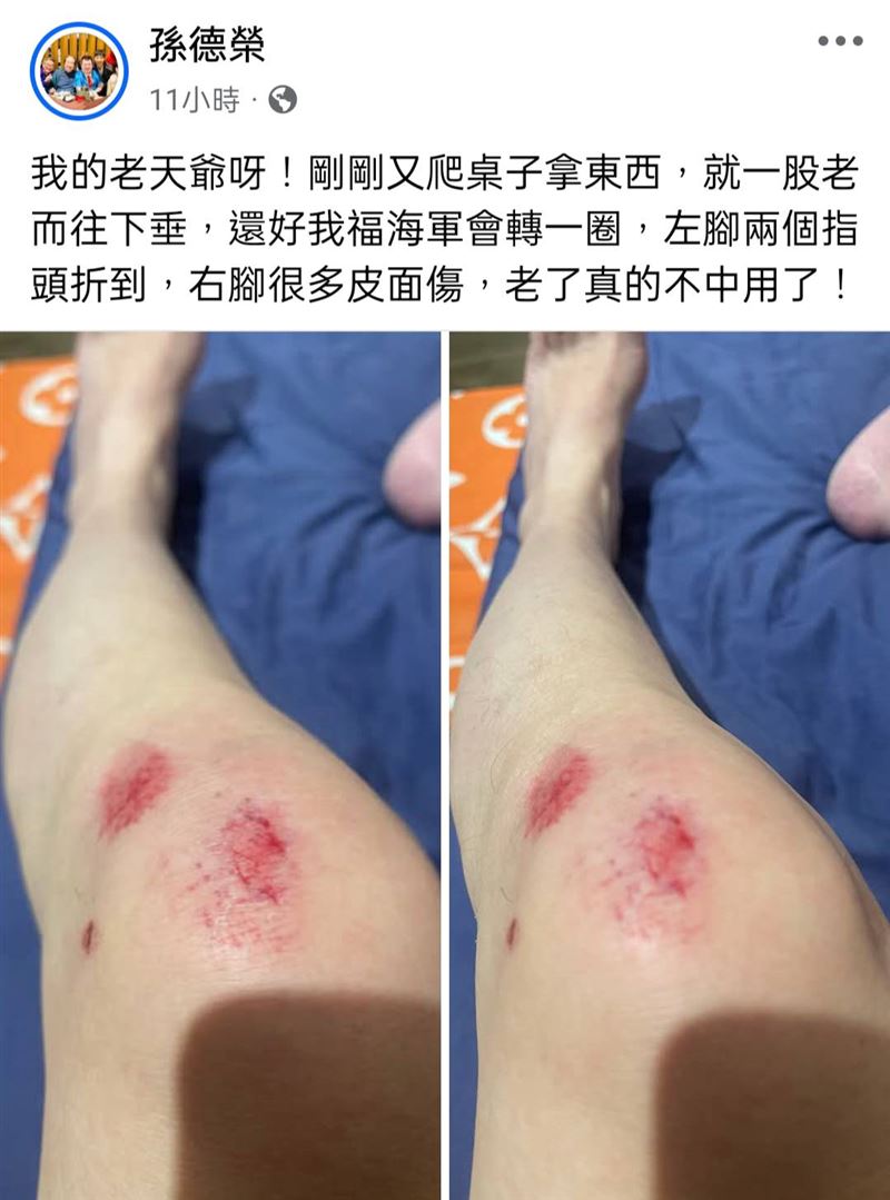 孫德榮摔傷。（圖／翻攝自孫德榮臉書）