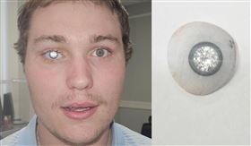 007反派來了？珠寶師6千萬義眼「鑲2克拉鑽石」　網友怕他被活摘器官。（翻攝畫面）