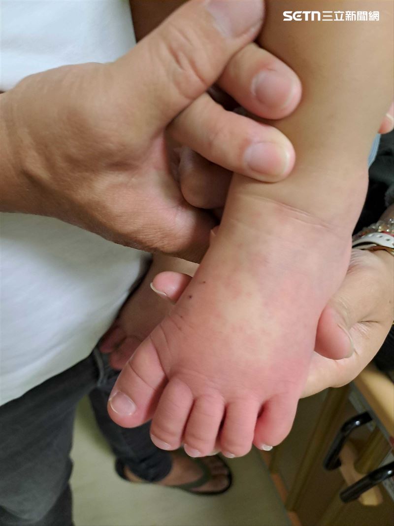 2歲男童就醫時手腳「腫得像麵龜」、雙眼佈滿血絲、嘴唇乾裂發紅,脾氣開始煩躁不安。(圖/翻攝畫面)