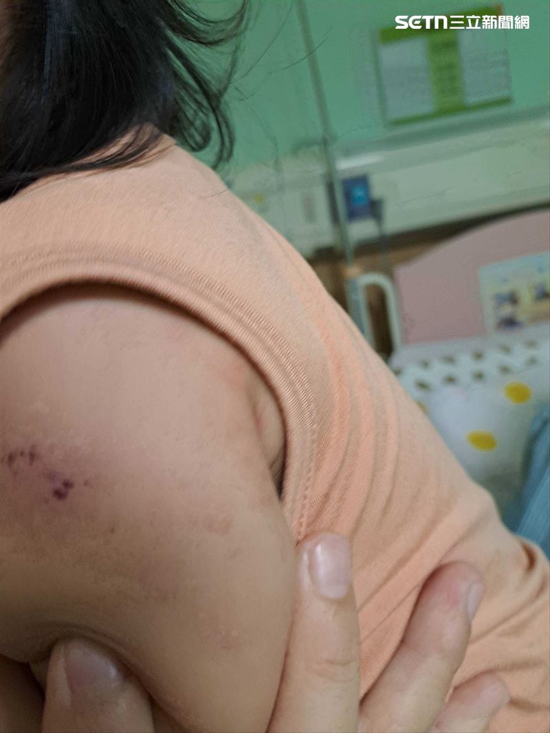 病童到院後立刻安排抽血,結果顯示發炎指數明顯上升,白血球、肝指數偏高,且有輕度貧血症狀,進一步做心臟超音波時,發現冠狀動脈有週邊白亮及末段無漸縮(lose of tapering)徵兆,確認是川崎病。(圖/翻攝畫面)