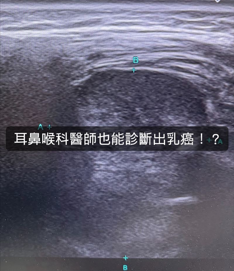 40多歲婦人持續3個多月有左側臉頰和下唇出現麻木症狀,並且牙齦刺痛,最後被而鼻喉科醫師驗出「乳癌轉移下頜骨」。(圖/翻攝自耳鼻喉頭頸外科張家豪醫師臉書)