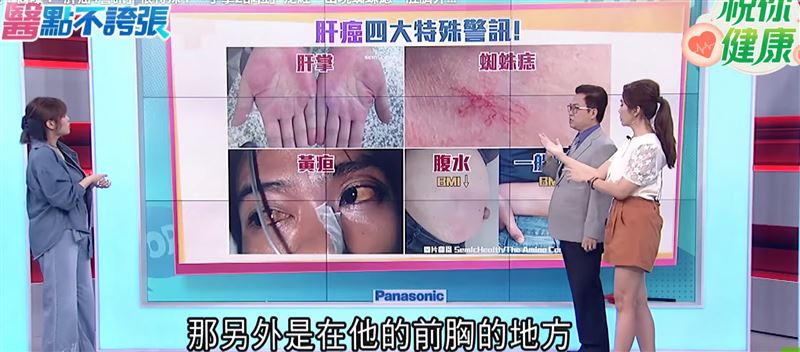 胃腸肝膽科醫師蕭敦仁分享4大肝癌末期警訊,一旦出現肝掌、蜘蛛痣、腹水、黃疸等症狀,要及早檢查肝臟健康。(圖翻攝自/祝你健康)