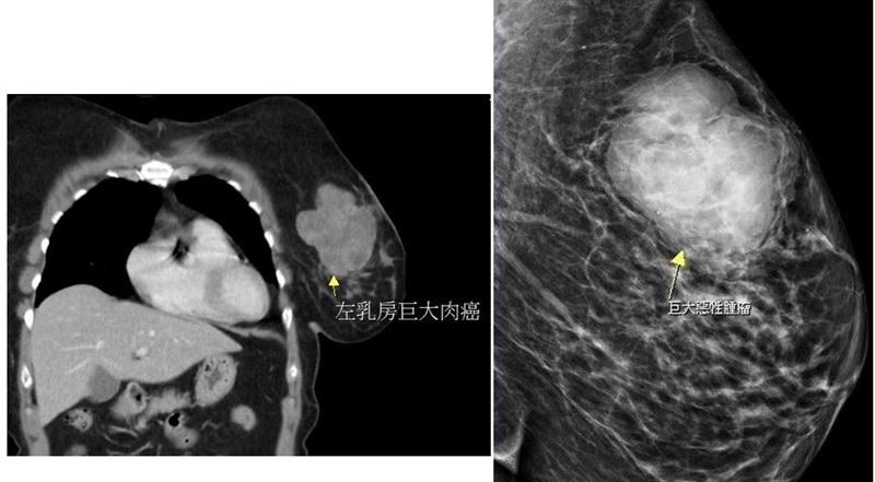病人經檢查發現左邊乳房有一將近10公分大的腫瘤,病理檢查竟是罕見肉癌。(圖/大千綜合醫院提供)