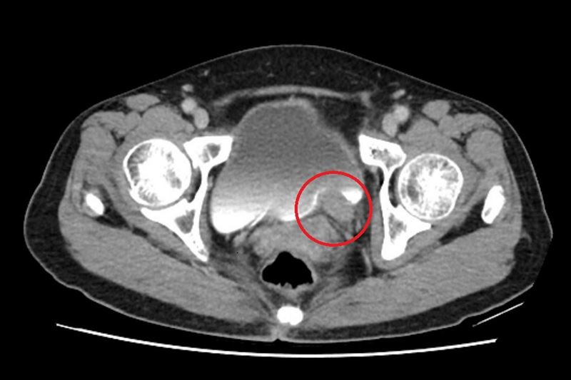 電腦斷層顯示,婦人左側輸尿管末端有一約5公分大腫瘤。(圖/台北慈濟醫院提供)