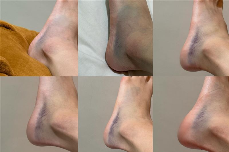 南珉貞腳踝整片瘀紫，傷勢非常嚴重。（圖／翻攝自南珉貞Threads）