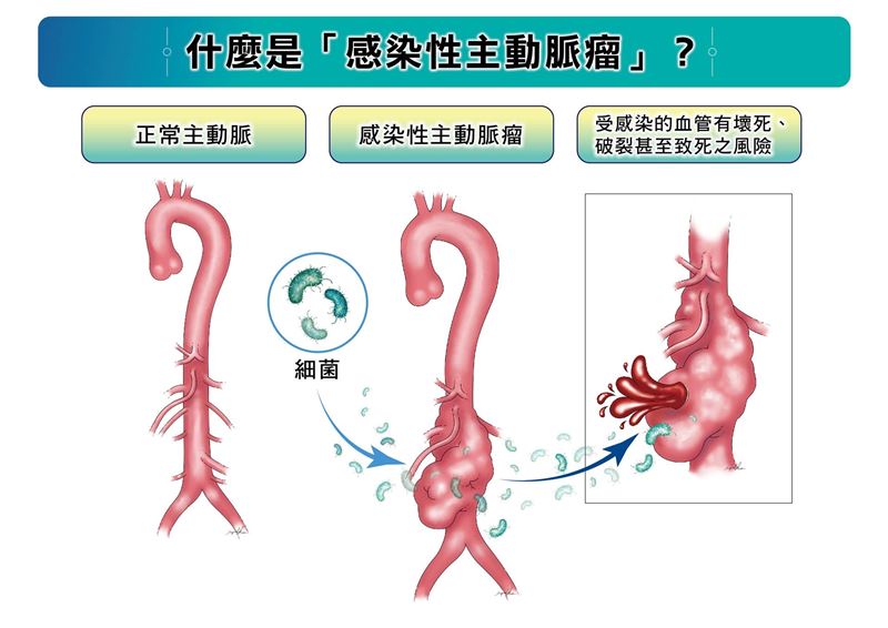 感染性主動脈瘤是由病原體(如細菌)入侵主動脈,導致血管壁壞死、破裂的罕見疾病,若未即時治療,死亡風險極高。(圖/長庚醫院提供)