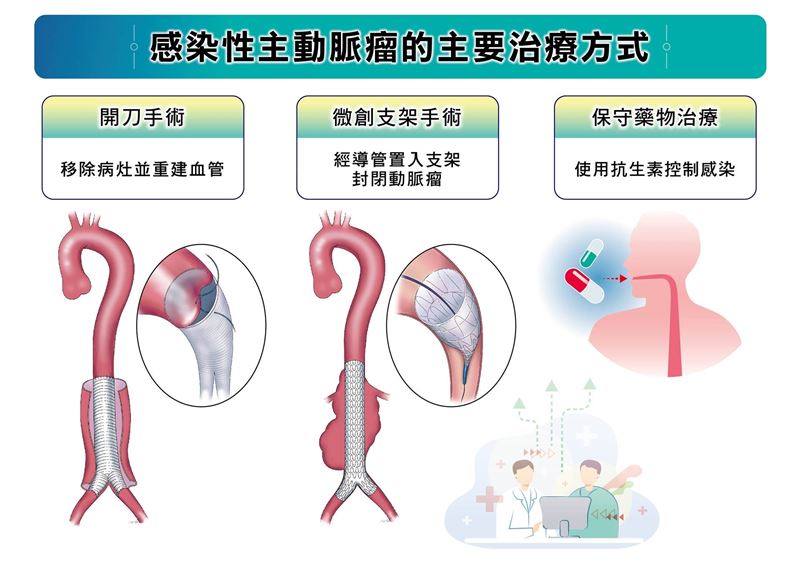 感染性主動脈瘤的三種主要治療方式:開刀手術、血管內微創修補以及保守藥物治療,不同方法各有適用情況。(圖/長庚醫院提供)