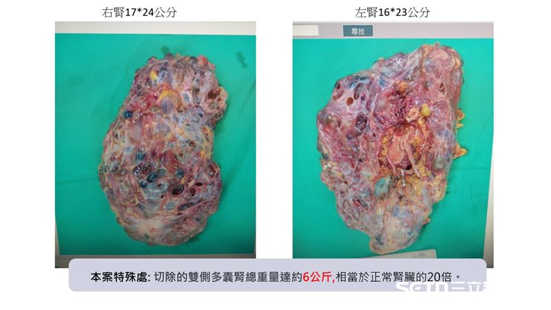 陳老師因多囊腎導致腎臟異常腫大,切除後雙側病腎合計重達6公斤為正常人的20倍。(圖/彰基授權提供)