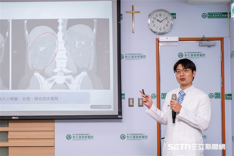 蔡俊傑醫師指出,陳老師當時的腎臟因多囊腎病變嚴重腫大,體積約為正常人的20倍,不僅壓迫周邊器官,還導致腎功能快速惡化,出現疲倦、水腫及血壓難以控制等症狀。由於腎臟體積過大,不利於進行移植手術,醫療團隊遂採用達文西微創手術先行切除雙側腎臟,再進行活體腎臟移植,最終順利完成治療,讓患者重獲健康。(圖/彰基授權提供)