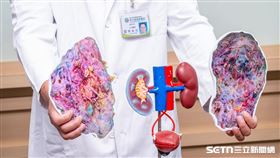 活體捐腎／彰基授權提供