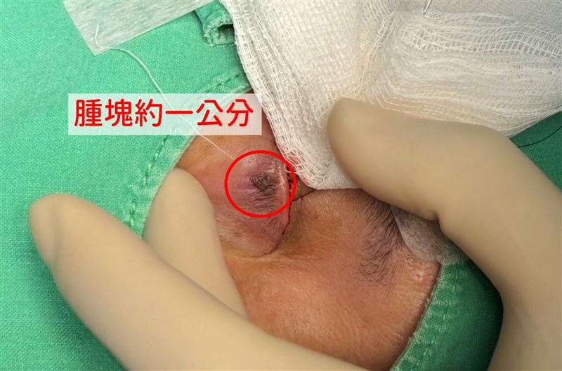 一名女子因眼皮下方長出不明腫塊，隨著腫塊增大至1公分，而影響視線，後經手術處理，擺脫被異物遮住的苦惱。（圖／中國醫藥大學新竹附設醫院提供）