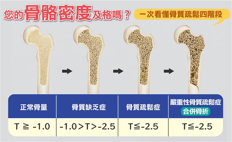目前診斷骨質疏鬆症最準確的方式為雙能量X光吸收儀（DXA），以腰椎與兩邊髖骨的骨密度T值為標準，T值介於-1至-2.5之間者，已出現骨質缺失的現象，一旦骨密度T值低於-2.5，即罹患骨質疏鬆症。（圖／聯新國際醫院提供）