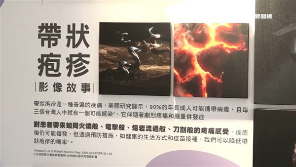 帶狀疱疹俗稱「皮蛇」，感染後疼痛難耐