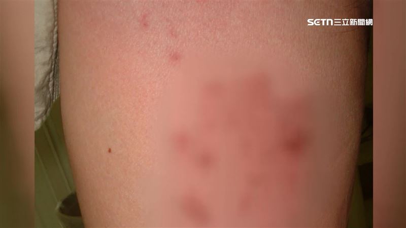 三高患者健康危機！流感、帶狀疱疹預防