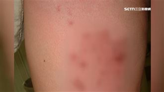 三高患者健康危機！流感、帶狀疱疹預防