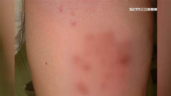 台灣每三個人可能就有一人感染帶狀疱疹