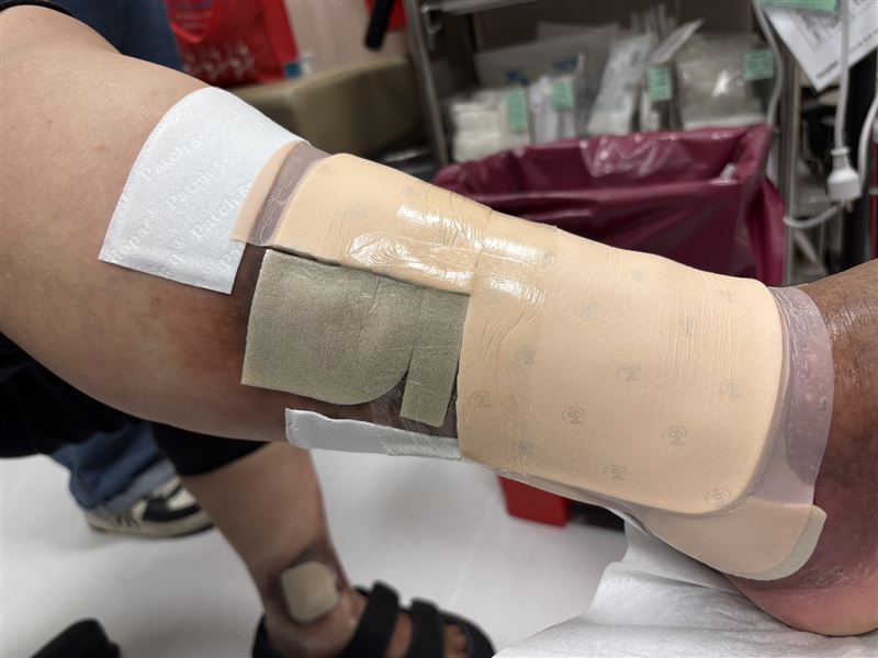 新竹一名婦人飽受靜脈曲張之苦，反覆治療無效，後輾轉找到翁啟峰，透過手術療程順利。（圖／安貞診所提供）