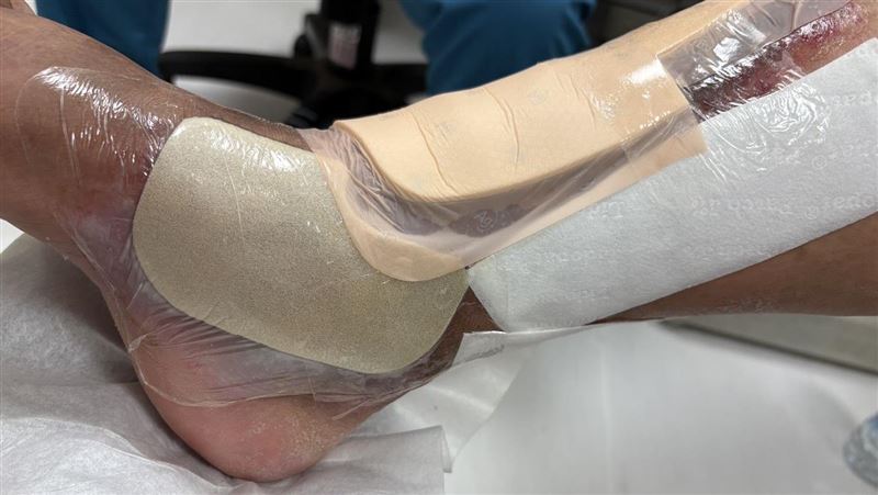 58歲婦「心肺衰竭」竟因腳上長「青筋」