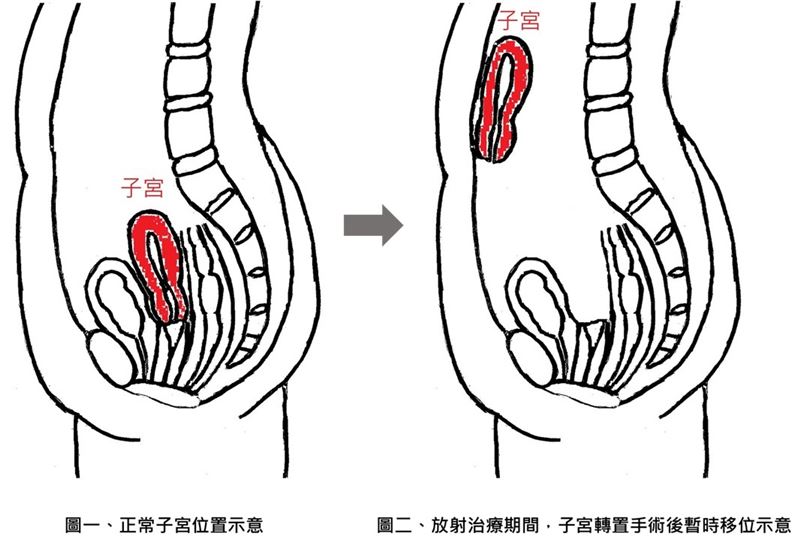 子宮轉置手術可在骨盆放療期間保護卵巢與子宮,治療結束後再復位,保留病患的生育可能。(圖/亞東醫院提供)