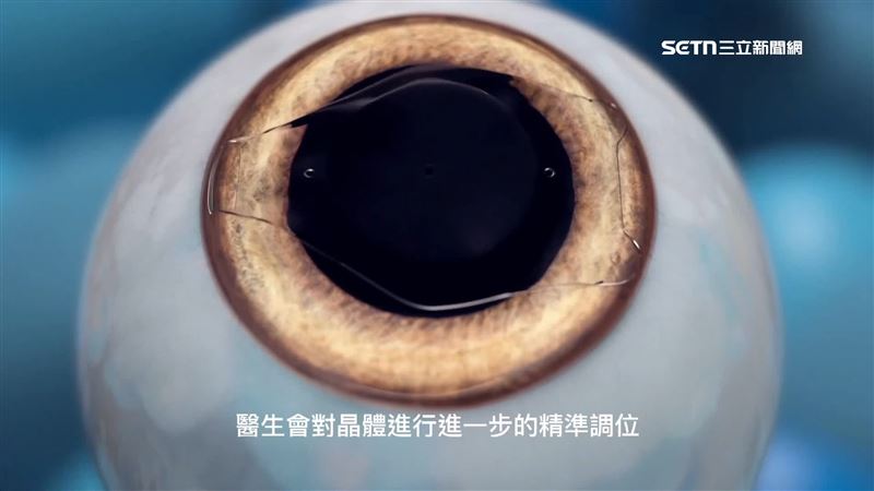 該項技術，是將膠原蛋白放入眼內，放置的位置是在虹膜跟水晶體中間