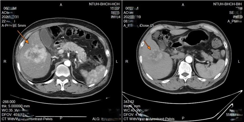 鎖骨下導管置放進行肝動脈內灌注化療,兩次療程後腫瘤明顯縮小。(左:治療前/右:兩次療程後)(圖/台大新竹分院提供)
