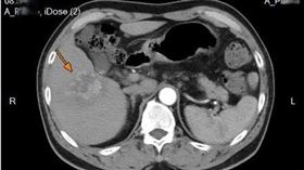 淋巴癌,肝癌,腫瘤,台大（圖／台大新竹分院提供）