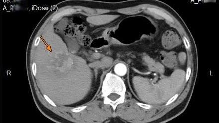 63歲男罹淋巴癌＋肝癌　做1事「變小了」