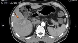 63歲男罹淋巴癌＋肝癌　做1事「變小了」