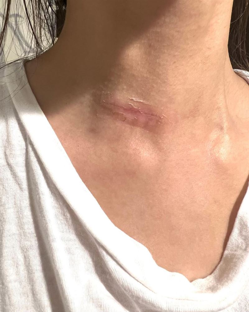 林欣霈右側甲狀腺與部分淋巴被切除(圖/翻攝自IG @verna_pei)