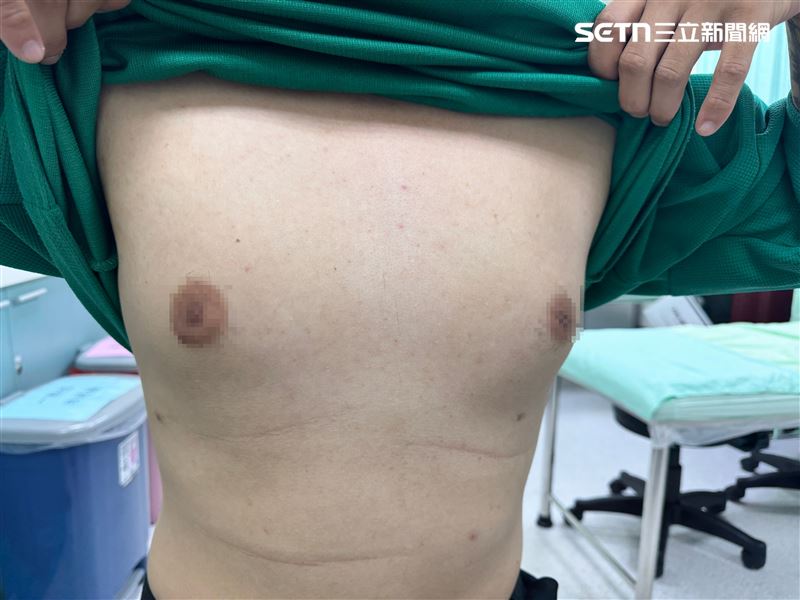 張先生透過微創腋下抽脂手術,順利移除多餘脂肪,恢復男性胸型。(圖/烏日林新醫院提供)