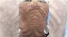 大陸南京一名40歲女子美美（化名）長年塗抹網購藥物，結果確診「繼發性腎上腺皮質功能減退」，醫師也指出藥膏成分是強效激素，對身體有害。（圖／翻攝自微博／揚子晚報）