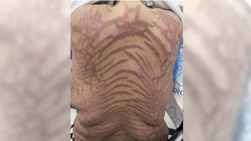 女擦「網紅神藥」全身斑紋！醫曝危險成分