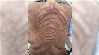 女擦「網紅神藥」全身斑紋！醫曝危險成分