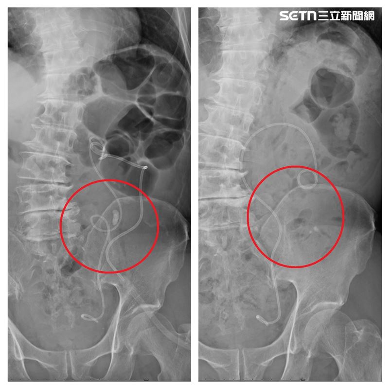 患者輸尿管嚴重彎曲，如同雲霄飛車軌道，鏡體根本無法進入，醫療團隊迅速啟用最新一代「7.5Fr軟式輸尿管鏡」，細如筆身，靈巧自如。（圖／翻攝畫面）