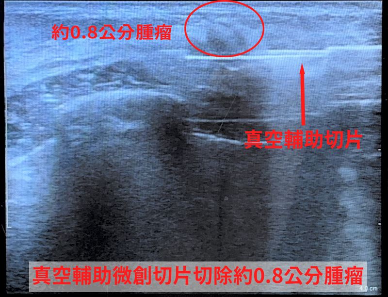 24歲女子乳房疼痛就醫，檢出0.8公分腫瘤。醫師以「真空輔助微創切片」取得更多組織、同步移除腫瘤，最終證實為良性，乳房外觀幾乎不受影響。（圖／中國醫藥大學新竹附設醫院提供）