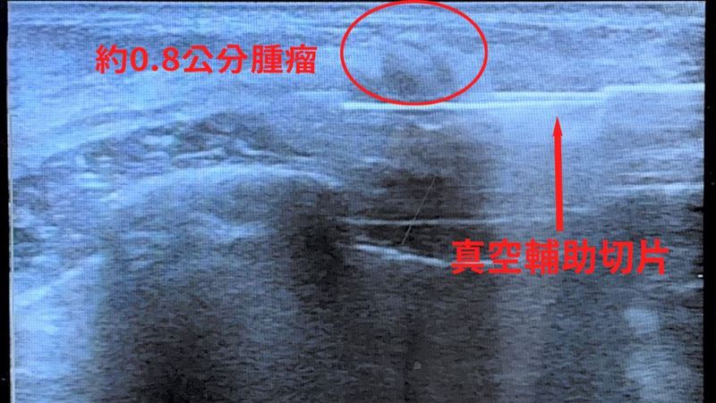 24歲女突胸痛！檢查見腫瘤　醫揭養瘤元凶