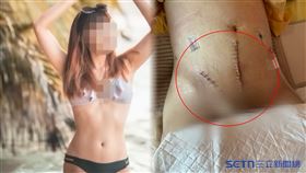 國軍高雄總醫院,衛生局,高雄,子宮肌瘤,刀疤,蜈蚣,手術,靜脈,醫療疏失（圖／民眾提供）