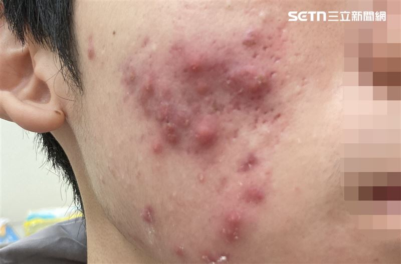 熬夜晚睡、工作/學業壓力過大、抽菸或者需要長期上妝也都會惡化痤瘡。（圖／翻攝畫面）