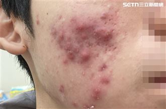 考試壓力吃炸物狂冒痘　高三生爛瘡長滿臉